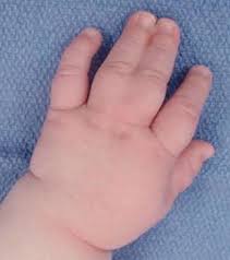 Dính ngón tay: Nguyên nhân, triệu chứng và cách điều trị